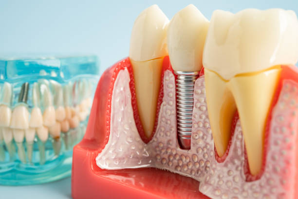 Best Root Canal Treatment  in Dillon, CO